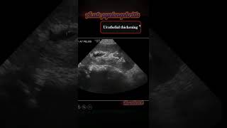 3 type acute pyelonephritis ultrasound viral ultrasoundstudent shortsfeed [upl. by Mauceri68]