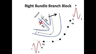 ECG course Bundle Branch Blocks Dr Sherif Altoukhy [upl. by Festus388]