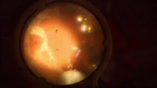 Choroidal Indentation After Combined Vitrectomy and Manual Intraoperative Suprachoroidal Viscopexy [upl. by Adikam]