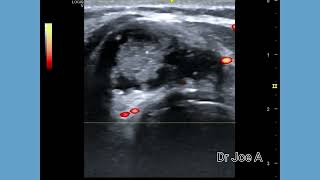 Papillary carcinoma thyroid Ultrasound and color Doppler video complex thyroid mass [upl. by Aneis]