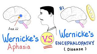 Wernicke’s Aphasia vs Wernickes Encephalopathy  Neurology [upl. by Chrysler740]