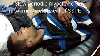 SLOW MYOCLONUS SSPESubacute Sclerosing Panencephalitis video [upl. by Loferski]