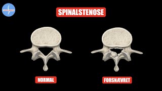 Hvad du bør vide om spinalstenose [upl. by Ahse]