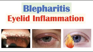 Blepharitis Eyelid Inflammation  Causes Risk Factors Signs amp Symptoms Diagnosis Treatment [upl. by Rotman347]