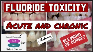 FLUORIDE TOXICITY II ACUTE AND CHRONIC II DENTAL FLUOROSIS II PUBLIC HEALTH DENTISTRY [upl. by Coheman853]