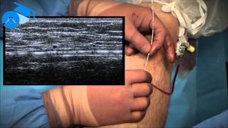 Positioning of endovenous catheter at the SaphenoFemoral Junction varicose veins [upl. by Ddahc]