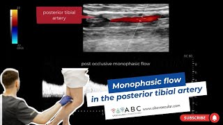 Monophasic flow in the posterior tibial artery  Ultrasound [upl. by Pavior234]