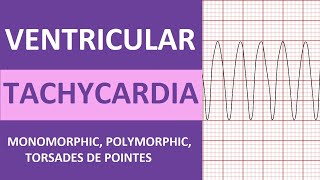 Ventricular Tachycardia Vtach ECG Interpretation Treatment Nursing NCLEX Review [upl. by Llenyl]