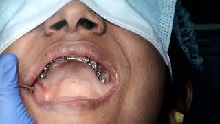 Additionally placed pterygoid implant in both right and left region in full mouth rehabilitation [upl. by Rowen]