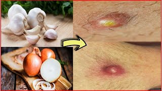 How to Get a Boil to Pop Overnight and Fast – Natural and best Home Remedies For Boils [upl. by Nikolia665]