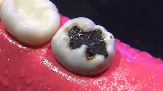 Ultimate Dental Rescue ASMR Tartar Removal Meets Root Canal Magic [upl. by Obola411]