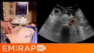 Ultrasound of Abdominal Aortic Aneurysm AAA [upl. by Fazeli]