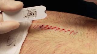 SutureOut The Easy Way to Remove Sutures [upl. by Ahsuatal704]