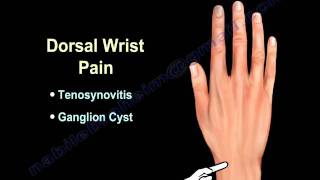 WRIST PAIN COMMON CAUSES  Everything You Need To Know  Dr Nabil Ebraheim [upl. by Htaras]