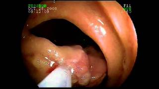 Using Capsule Endoscopy and Double Balloon Enteroscopy for Complex Small Intestinal Disease [upl. by Bonne816]