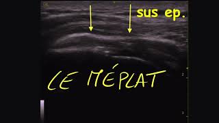 Echo Tuto Epaule 4 le tendon supra épineux normal et pathologique [upl. by Uke]