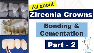 Zirconia Crowns  CEMENTATION vs BONDING [upl. by Nosloc]