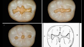 Class I  cavity prepration with Buccal pit amp Buccal extension  Mandibular 1st molar [upl. by Asillam]