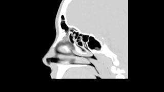 Saggital CT Scan of a right antrochoanal polyp [upl. by Yoshi]