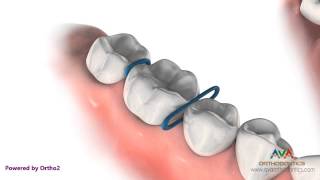 Orthodontic Separator or Spacer  Rubber ORings [upl. by Arem]