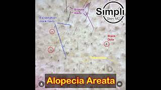 Alopecia Areata Dermoscopy [upl. by Adamec142]