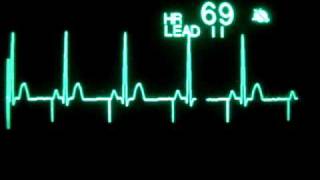 Atrial Pacing [upl. by Brothers]