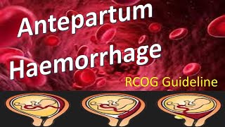 Antepartum Haemorrhage  RCOG Guideline [upl. by Mcdonald]