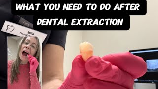 How to Care for Your Mouth After Dental Surgery [upl. by Edrahc]