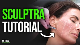 How to Inject Sculptra for Facial Volume Loss amp Glowy Skin  Full Procedure Demonstration [upl. by Novla601]