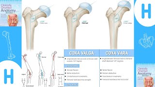 Coxa Valga and Coxa varafull description Coxavalga coxavara trending [upl. by Aissilem550]