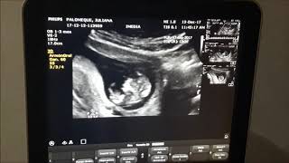 Nuestro bebe de 3 meses Ultrasonido [upl. by Ainaj]