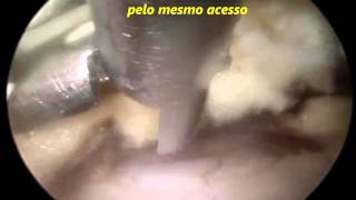 Vídeo Endoscopia de Coluna  Estenose de Canal Vertebral Lombar L45  Dr Marco Moscatelli [upl. by Morly]