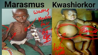 Protein Energy Malnutrition Biochemistry  Marasmus Vs Kwashiorkor  Kwashiorkor  Marasmus [upl. by Noyes]