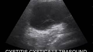 CASE 472 CYSTITIS CYSTICA [upl. by Haag]