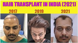 Hair Transplant result after 4 years 2021 INDIA [upl. by Niuqaoj739]