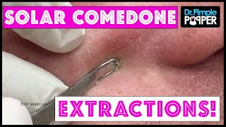 Great BLACKHEAD Extractions [upl. by Song286]