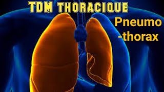 SCANNER THORACIQUE Pneumothorax avec collapsus passif [upl. by Fortunia553]