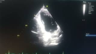 akinetic septum hypokinetic mid apical anterior and inferior wall moderate Lv [upl. by Keldon63]