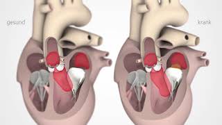Was ist eine Mitralklappeninsuffizienz [upl. by Eissat920]