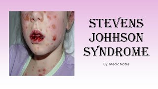 StevensJohnson syndrome [upl. by Aenaj507]