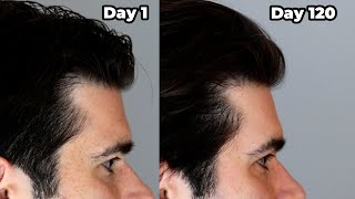 I put ROSEMARY OIL in My HAIR Everyday  120 Day Results [upl. by Amyas]