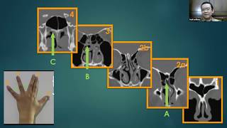 Paranasal Sinuses CT  A map toward safe endoscopic sinus surgery [upl. by Ajile]