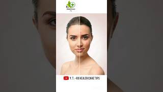 acnestar gel uses  pimpal amp acne removals cream  पिंपल के लिए क्रीम [upl. by Cindelyn]