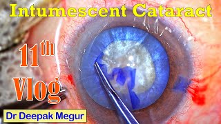 Cataract Vlog No11 Phacoemulsification Full Cataract surgery video  Dr Deepak Megur [upl. by Aronow]