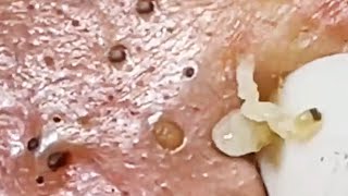 Extraction profonde des points noirs Acné kystique et popping 17 [upl. by Eenolem640]