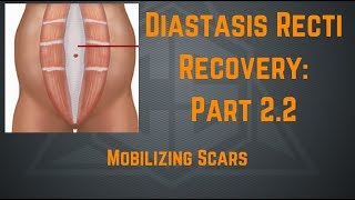 Diastasis Recti Recovery Part 22  Mobilizing Scars [upl. by Demodena]