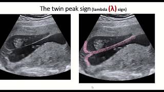 Twin peak sign or lambda sign  feature of dichorionic diamniotic twin pregnancy [upl. by Pulchi]