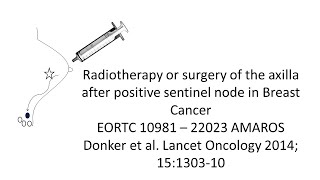 Radiation to Lymph nodes versus axillary dissection after positive SLNB AMAROS Study Breast Cancer [upl. by Catharina743]