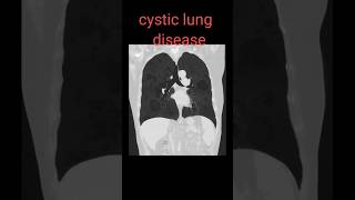 cystic lung disease shorts radiology lungsdisease radiologyjunction [upl. by Mehsah625]