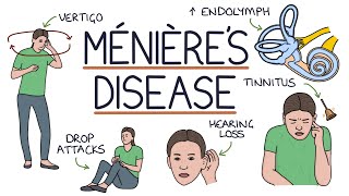 Understanding Ménière’s Disease [upl. by Cosmo]